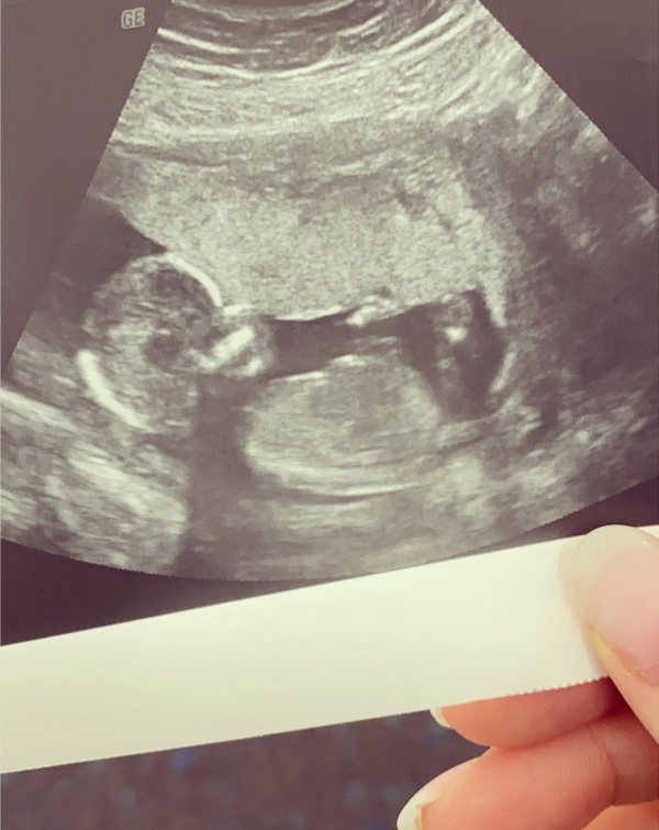 Ultraschallbild 15. Schwangerschaftswoche SSW15